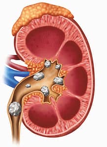 Kidney Stones, Health remedies, Home remedies, DNS Ayurveda, Kidney Ki Pathari
