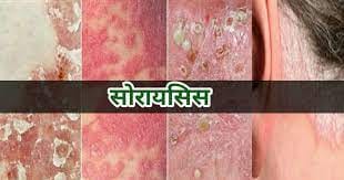Psoriasis In Hindi