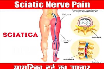 Sciatica Nerve Pain Treatment, eating before sex, Best Ayurveda clinic, Sexologist in lucknow, Herbal clinic, Piles clinic in lucknow