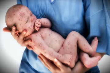 measles-in-america-after-19-years