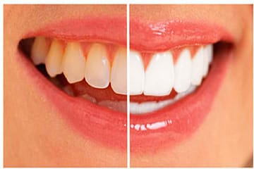 Home remedies for teeth whitening