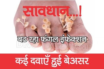 फंगल इन्फेक्शन | 4 गुना बढ़े मरीज, 5 में से 4 दवाइयां हुईं बेअसर