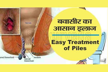 बवासीर या पाइल्स का आयुर्वेदिक इलाज | Ayurvedic treatment for piles in hindi