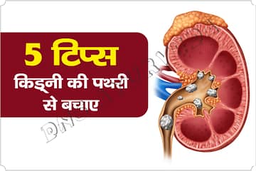 Kidney Stones, Health remedies, Home remedies, DNS Ayurveda, Kidney Ki Pathari