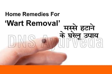Top 10 home remedies for wart removal