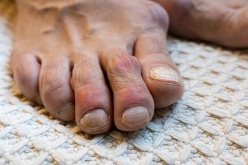 Uric Acid, यूरिक एसिड के रोगी भूलकर भी न खाएं दही, इन चीज़ों से भी करें परहेज