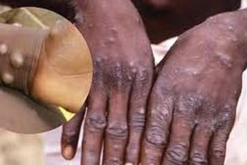 कोरोना के बाद Monkeypox, केरल में ऑटो और टैक्सी ड्राईवर में मिले लक्षण