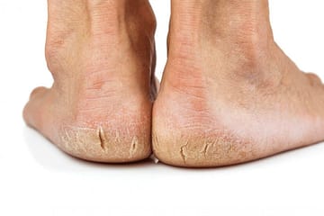 Cracked Heels, फटी एड़ियो को ठीक करने के रामबाण घरेलू उपचार