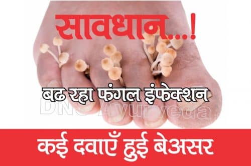 फंगल इन्फेक्शन | 4 गुना बढ़े मरीज, 5 में से 4 दवाइयां हुईं बेअसर