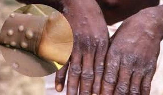 कोरोना के बाद Monkeypox, केरल में ऑटो और टैक्सी ड्राईवर में मिले लक्षण