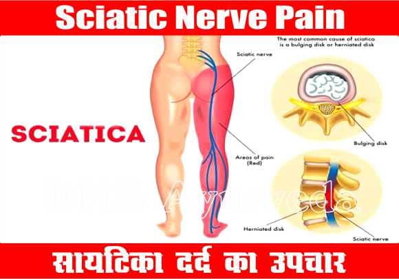 Sciatica Nerve Pain Treatment, eating before sex, Best Ayurveda clinic, Sexologist in lucknow, Herbal clinic, Piles clinic in lucknow