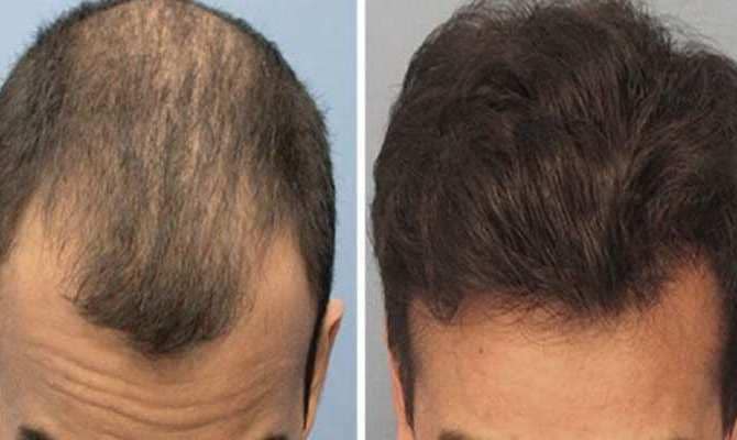 Ganjapan Ka ilaj In Hindi, Hair Problem Treatment in Hindi