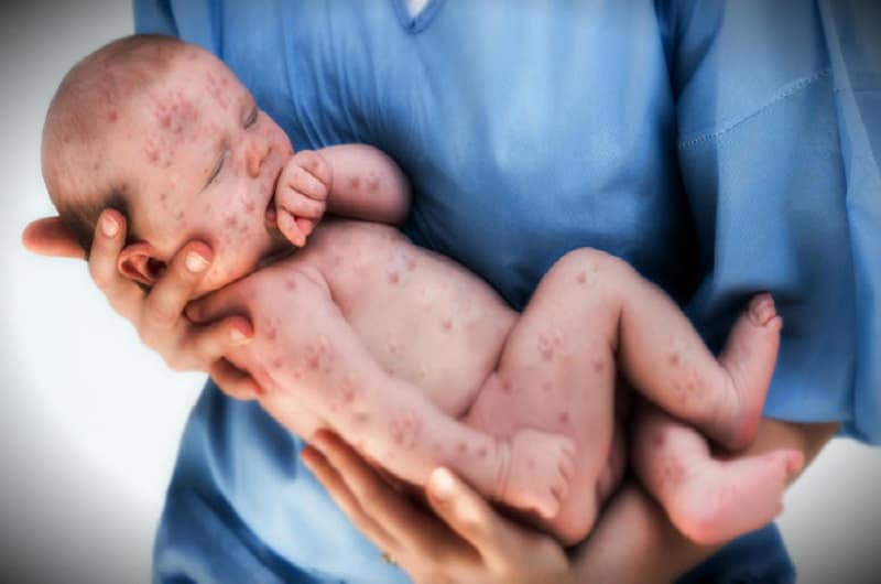 measles-in-america-after-19-years