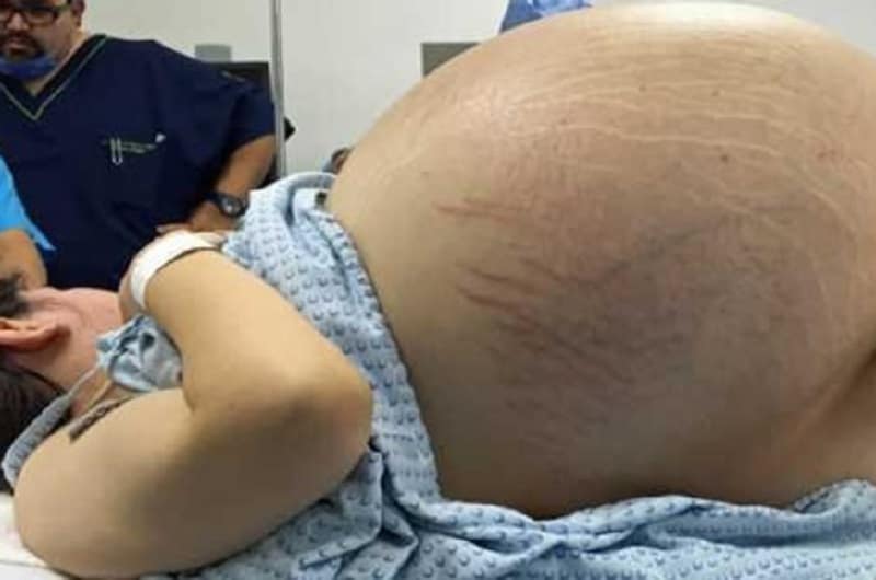 tumor in uterus of a pregnant lady