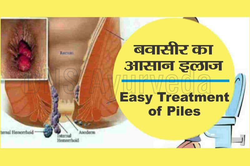बवासीर या पाइल्स का आयुर्वेदिक इलाज | Ayurvedic treatment for piles in hindi