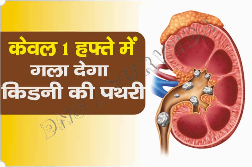 Kidney stone treatment | केवल 1 हफ्ते में गला कर निकाल देगा ये खास नुस्ख़ा